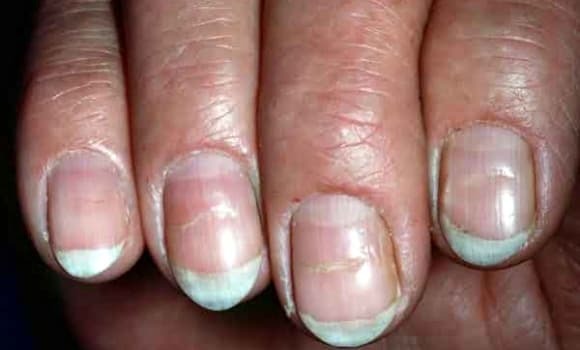 Móng tay xuất hiện các rãnh dọc rõ, giòn và dễ gãy có thể liên quan đến ung thư Shbet123 Link Vào ShBet Mới Nhất hoặc ung thư thực quản.