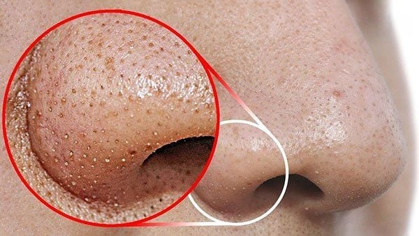 Có thể sử dụng miếng dán hoặc tinh chất chứa niacinamide, rau má hay các chiết xuất làm dịu da