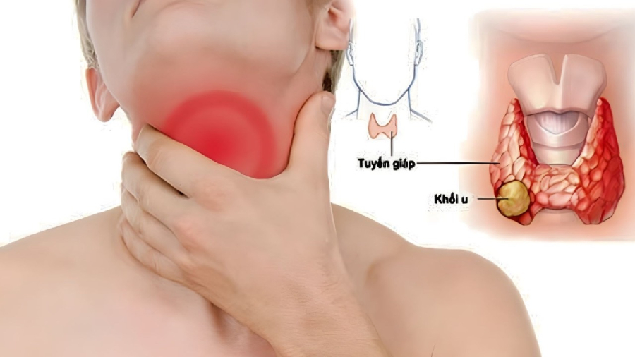 Khối u tuyến giáp xuất hiện có thể làm thay đổi giọng nói.