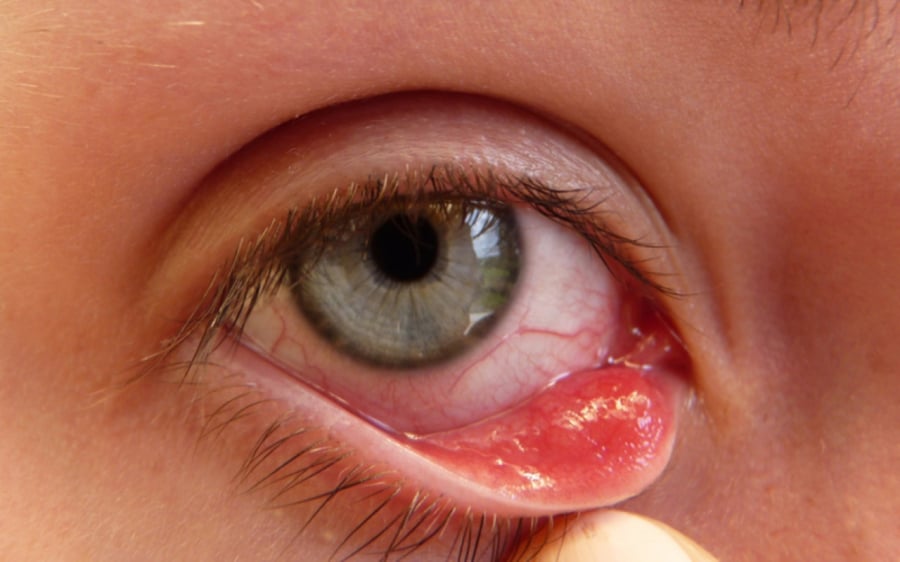Viêm kết mạc do virus là một trong những bệnh dễ lây lan nhất trong cộng đồng. (Ảnh minh họa)