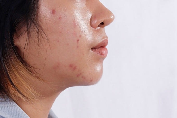 Một trong những lỗi thường gặp nhất là sử dụng kem chống nắng không phù hợp với loại da.