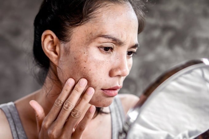 Nếu không thoa lại định kỳ, da gần như bị “phơi nắng” trong nhiều giờ liền, dẫn đến tình trạng sạm da, cháy nắng và tổn thương tích lũy theo thời gian.