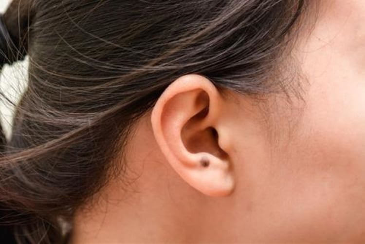 Nốt ruồi ở tai (vành tai, thùy tai). (Ảnh minh họa)