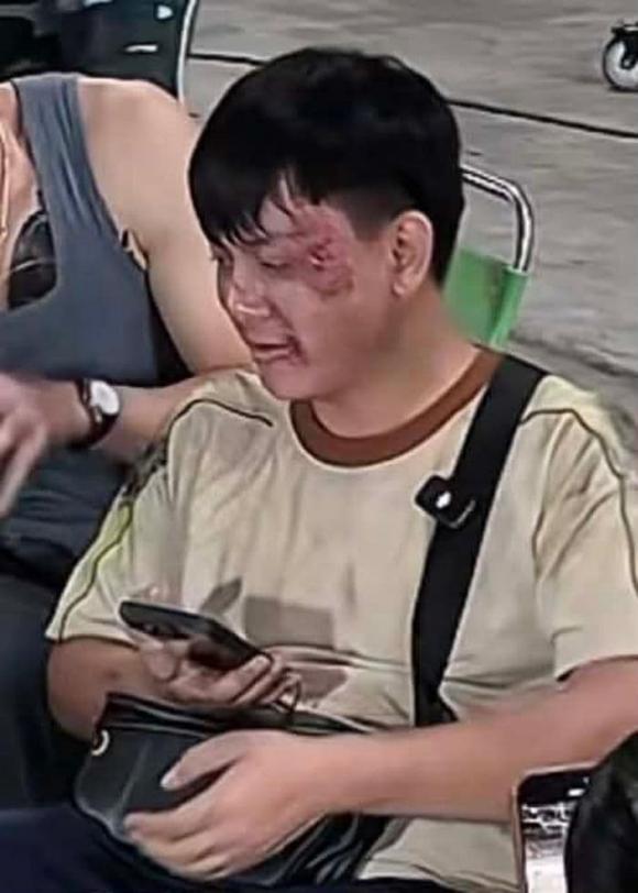  Hoài Lâm xuất hiện với gương mặt chi chít vết trầy xước, bầm tím, thần sắc mệt mỏi.