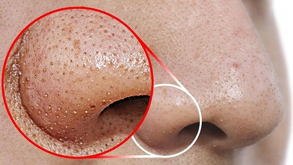 Do miệng nang lông mở trên bề mặt da, phần nhân mụn tiếp xúc trực tiếp với không khí và xảy ra quá trình oxy hóa, khiến chúng dần chuyển sang màu sẫm đặc trưng.