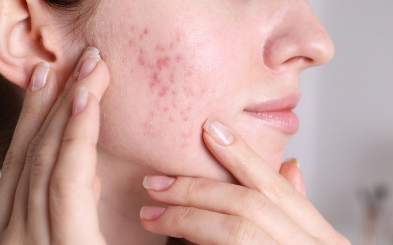 Đối với những trường hợp thâm mụn lâu năm hoặc cần cải thiện nhanh, các phương pháp công nghệ cao mang lại hiệu quả rõ rệt hơn.