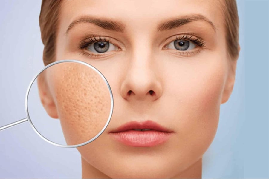 Một trong những nguyên nhân chính khiến lỗ chân lông trông to hơn là sự tích tụ của dầu thừa, bụi bẩn và cặn trang điểm.
