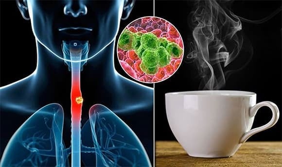 Giải thích được chấp nhận rộng rãi nhất hiện nay là hiện tượng “chấn thương nhiệt”. 
