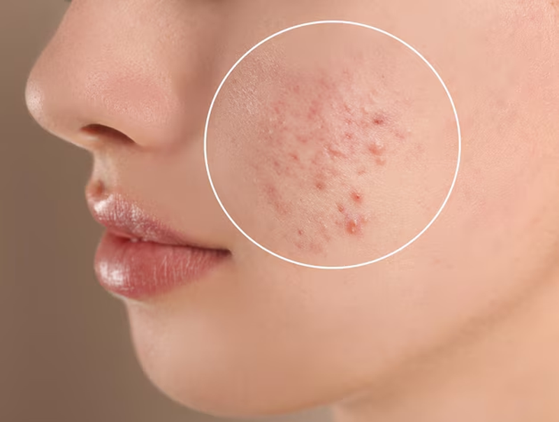 Nếu không được chăm sóc đúng cách, nguy cơ viêm nhiễm, để lại thâm hoặc sẹo là rất cao.