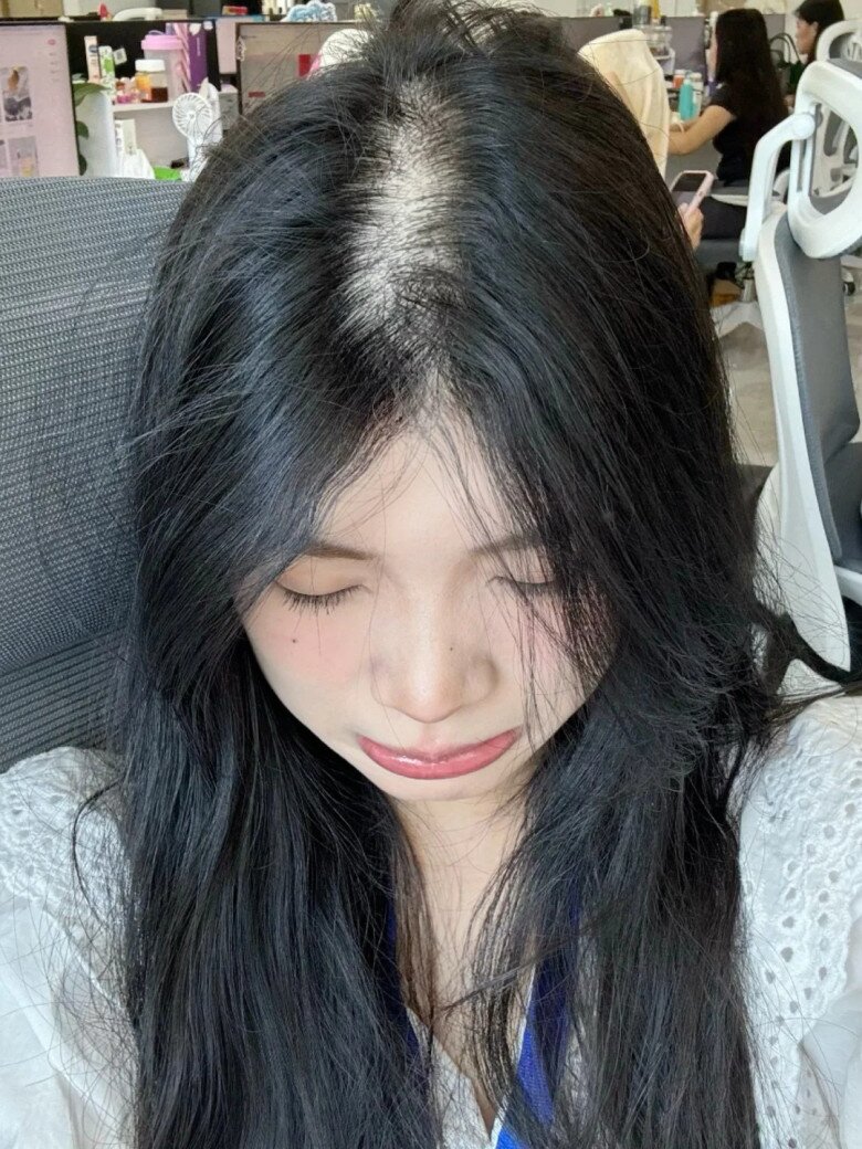 Khi da đầu thường xuyên trong trạng thái nhờn, dễ bết, thậm chí xuất hiện các nốt kích ứng nhỏ, đó là dấu hiệu cho thấy môi trường da đầu đang bị rối loạn