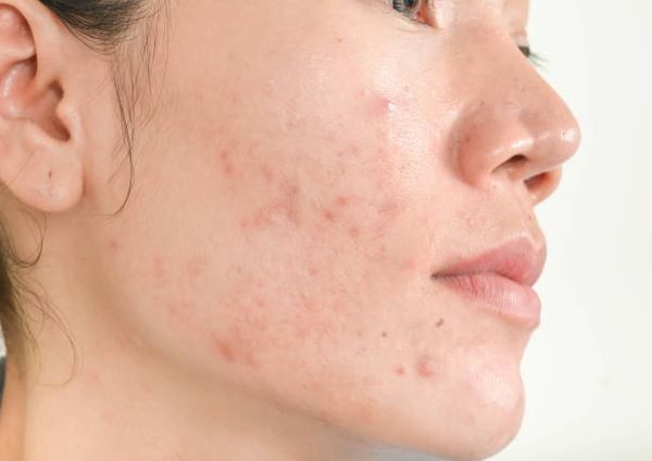 Nguyên nhân phổ biến dẫn đến mụn ẩn thường xuất phát từ việc lỗ chân lông bị bít tắc bởi dầu thừa, bụi bẩn và cặn trang điểm. 