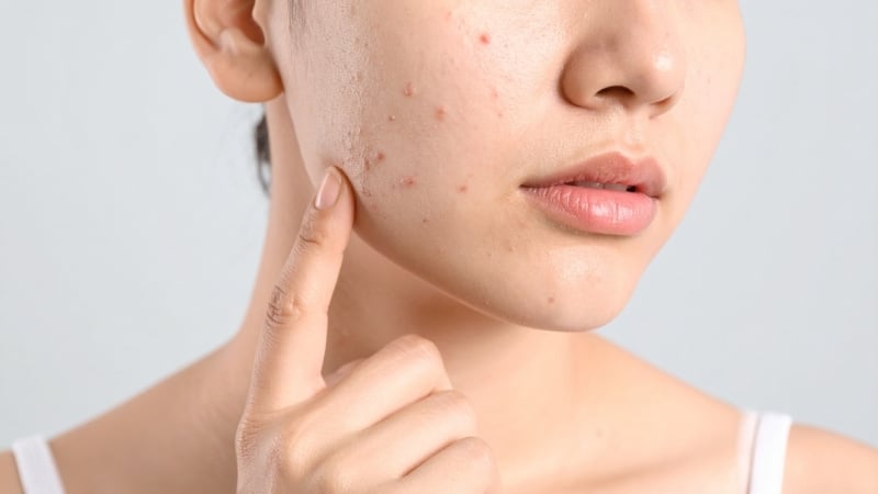 Retinoid được xem là hoạt chất có hiệu quả cao. Thành phần này giúp thúc đẩy quá trình tái tạo tế bào, giảm tình trạng bít tắc lỗ chân lông