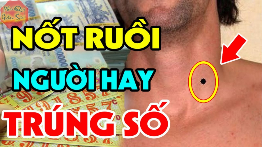 Nốt ruồi may mắn trên người đừng dại xóa đi
