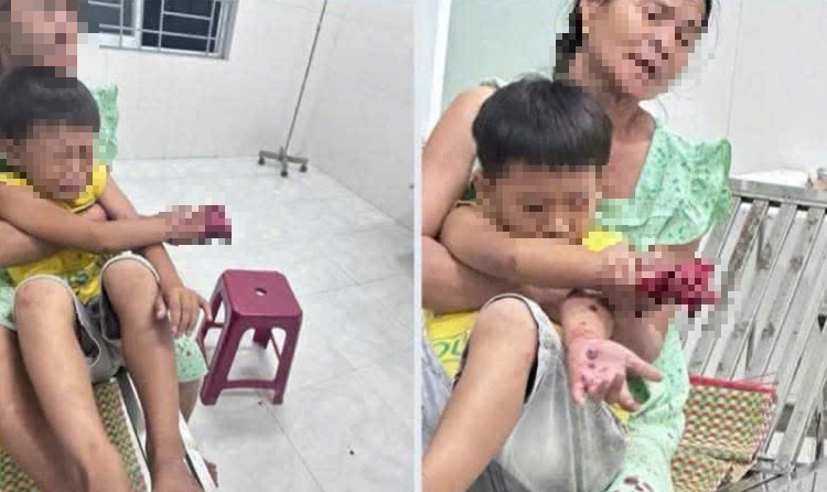 Ngày 29-4, Bệnh viện Đà Nẵng xác nhận đang tiếp nhận và điều trị cho một bệnh nhi bị thương nặng ở bàn tay phải, nghi do điện thoại phát nổ trong lúc sử dụng.    