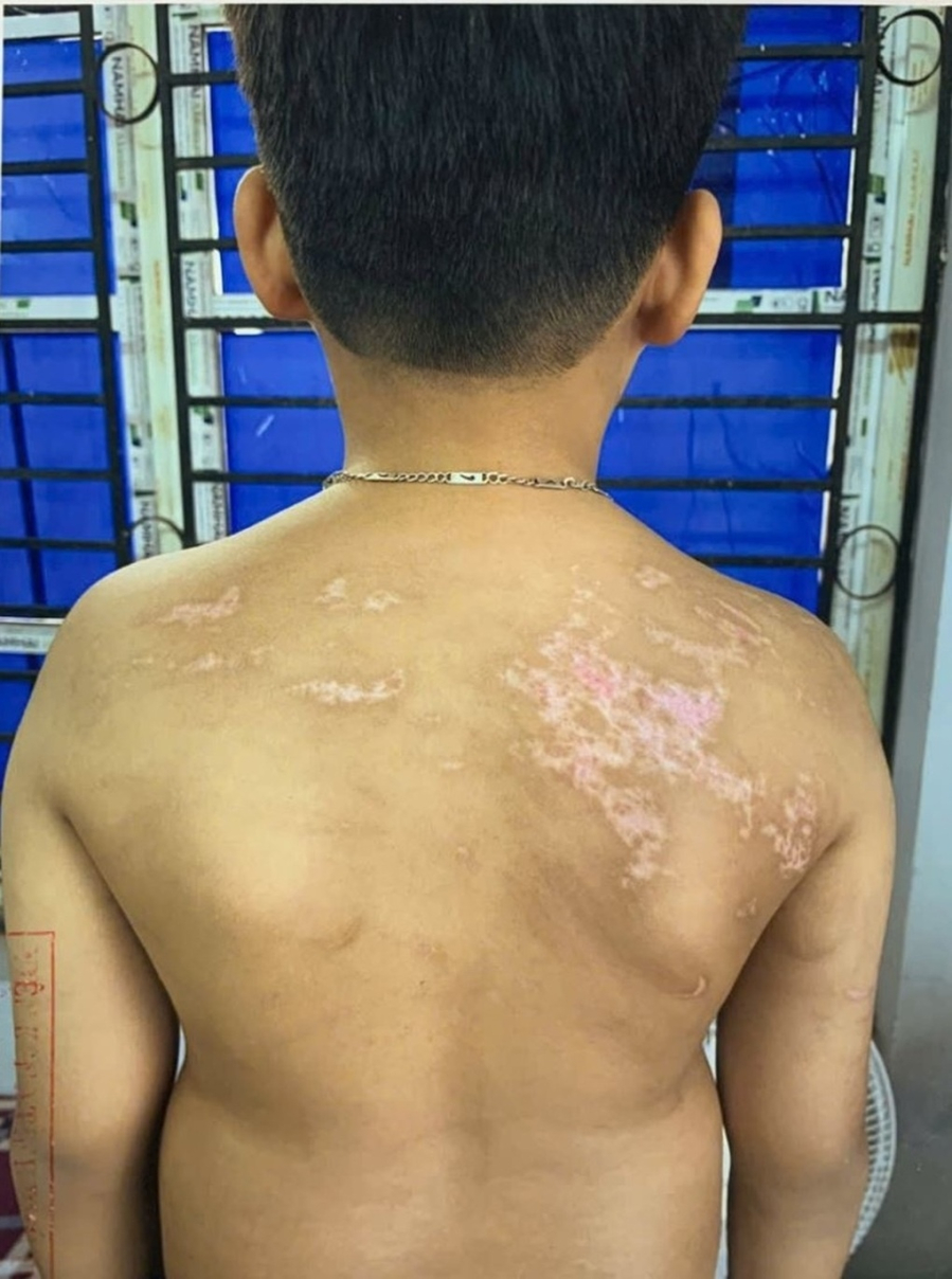 Sau sự việc, Chung phát hiện các vết thương trên Sh88bet đăng ký miễn phí con nhưng chỉ dùng tinh dầu xịt lên vết thương rồi để cháu đi ngủ. Vụ việc sau đó được cơ quan chức năng vào cuộc điều tra, xử lý theo quy định pháp luật.    