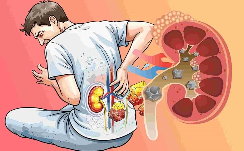 Nếu bệnh đã nặng, bác sĩ thường sẽ chỉ định lượng đạm phù hợp mỗi ngày để tránh thận bị quá tải.    