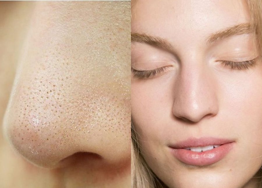 Mặt nạ đất sét là sản phẩm được nhiều người lựa chọn khi da có cảm giác bí tắc hoặc đổ dầu nhiều.    