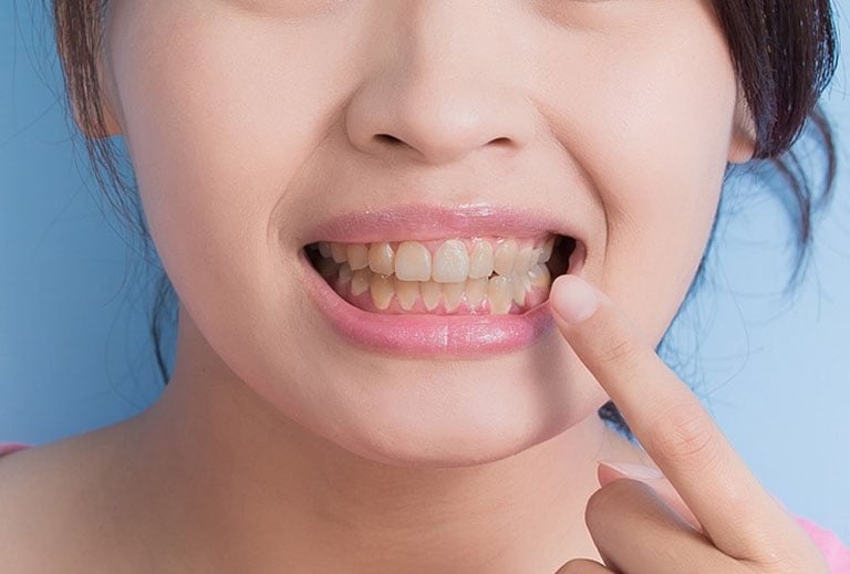 Khi sử dụng liên tục trong thời gian dài, các sắc tố này sẽ tích tụ và khiến răng chuyển sang màu vàng hoặc nâu nhạt.