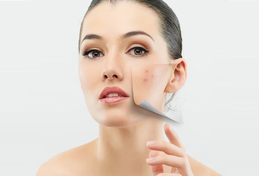 Axit azelaic ngày càng được yêu thích nhờ khả năng hỗ trợ cải thiện mụn và làm mờ vùng da tăng sắc tố sau viêm.