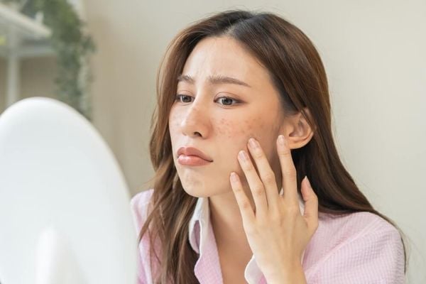 Khi thời tiết nóng lên, da thường tiết dầu nhiều hơn để duy trì độ ẩm tự nhiên. 
