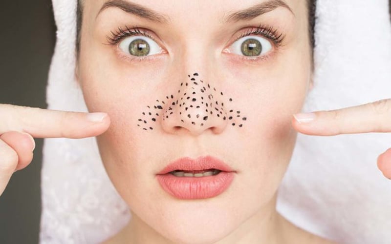  Khi dầu thừa, tế bào chết và mỹ phẩm tích tụ trong nang lông, mụn đầu đen sẽ dễ hình thành hơn.
