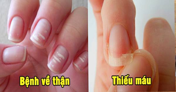 Cảnh báo bệnh nan y thông qua biểu hiện ở móng tay