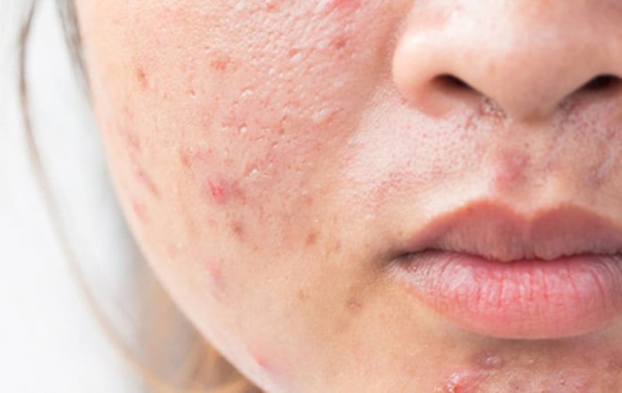  Với khả năng tan trong dầu, BHA có thể đi sâu vào lỗ chân lông để loại bỏ dầu thừa và tế bào chết tích tụ, từ đó giúp giảm nguy cơ bít tắc và hạn chế hình thành mụn mới.