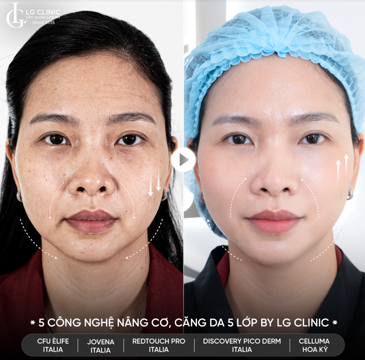 Rãnh cười sâu, da chảy xệ và sạm nám được cải thiện rõ rệt bằng 5 công nghệ nâng cơ căng da 5 lớp tại LG Clinic
