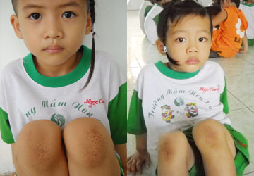 Bé Đặng Hoàng Châu với các vết đaubị hành bằng gai mít để lại như tổ ong.