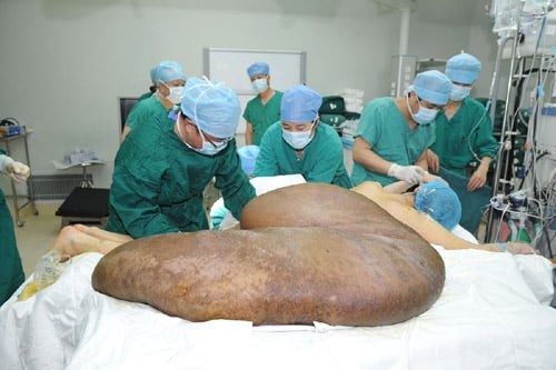 Các bác sỹ đang tiến hành loại bỏ khối u nặng 110kg khỏi Sh88bet đăng ký miễn phí cho anh Yang Jianbin, 37 tuổi, đến từ tỉnh Sơn Tây, Trung Quốc Trung Quốc.