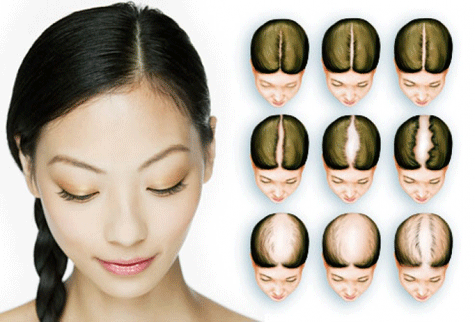 8 mẹo trị hói đầu hiệu quả