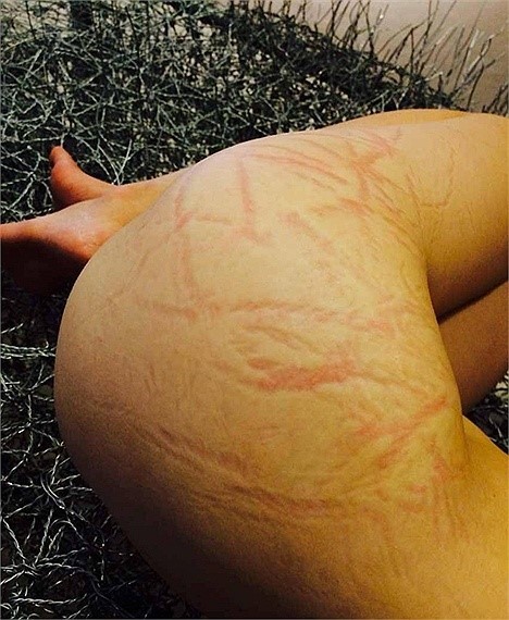 Vết dây thép gai in trên người nữ nghệ sĩ Chu Khiết.