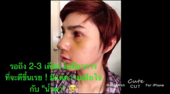 Gương mặt đã trở lại bình thường nhưng không còn đẹp như sau lần Shbet888 tiền thưởng cực khủng thứ nhất nữa.