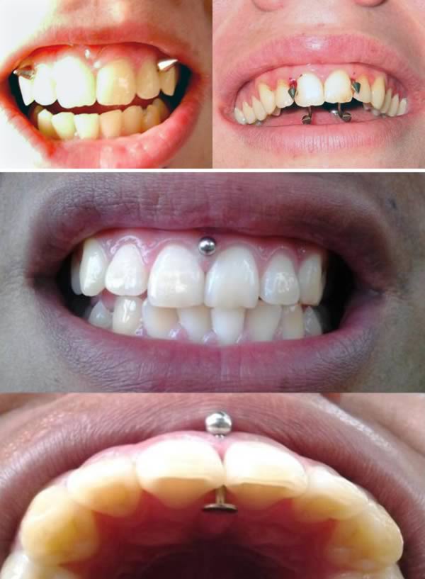Xỏ khuyên cho lợi là một phương pháp làm đẹp vô cùng đau đớn. Bạn phải dùng nhiều thủ thuật đặc biệt để đục lỗ cho lợi và đeo khuyên cho nó. Dù là một phương pháp làm đẹp đáng sợ, nhưng rất nhiều bạn trẻ vẫn tìm đến loại làm đẹp này để thể hiện cá tính.