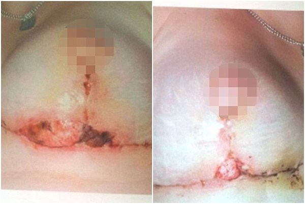 Ban đầu, cô rất hài lòng với kích cỡ vòng 1 mới nâng của mình, nhưng sau khi trở về nhà 1 tuần, cô vẫn thấy đau đớn và rò rỉ dịch.