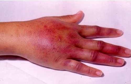 Vết thương do sâu bướm Lonomia obliqua gây nên.