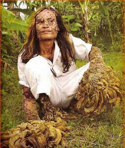 Bệnh tree bark skin disorder là một căn bệnh về da. Bệnh khiến vẻ ngoài con người có hình dạng khá đáng sợ.