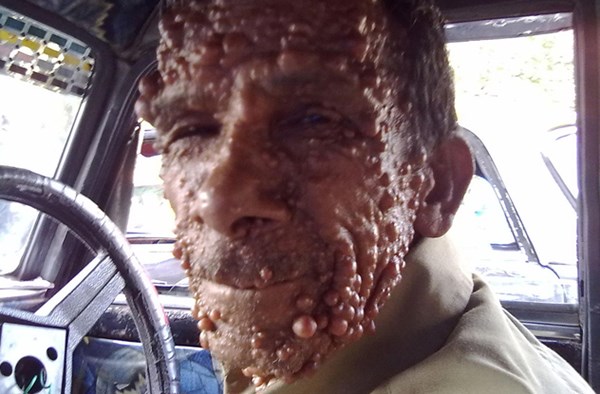 Bệnh u sợi thần kinh (Neurofibromatosis) là bệnh hệ thần kinh gây ra các khuyết tật da và các khối u trên các mô thần kinh. Những người mắc bệnh này rất hay bị xa lánh do đặc điểm xấu xí và ghê sợ.