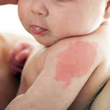Cứ 3 trẻ lại có một trẻ bị bớt. Đây là thực tế mà chắc chắn làm nhiều mẹ ngạc nhiên. Tỷ lệ bé gái có bớt nhiều hơn con trai.