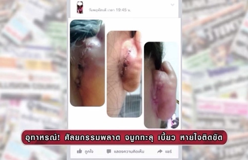 Cắt sụn tai để ghép mũi.