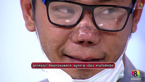 Chiếc mũi hiện tại của Kun Nat.