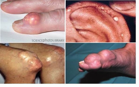 Các biến chứng của bệnh Gout có thể bao gồm khối u nhỏ hình thành dưới da (được gọi là tophi), gây tổn thương khớp, bệnh sỏi thận và cơn đau do Gout tấn công có thể ảnh hưởng Shbet16 chơi game trực tuyến hàng ngày của người bệnh.