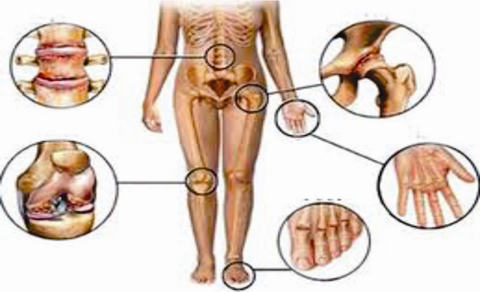 Đặc biệt đã bị gout mạn tính thì tình trạng bệnh rất nặng nề. Hầu hết các khớp biến dạng, vận động rất khó khăn, các khớp đau nhiều vì viêm cấp khớp, chất lượng sống bị giảm sút, kéo theo chi phí điều trị tốn kém.
