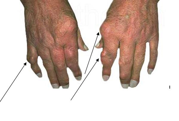 Bệnh này sẽ phá hủy những khớp tay, khớp chân đầu tiên.