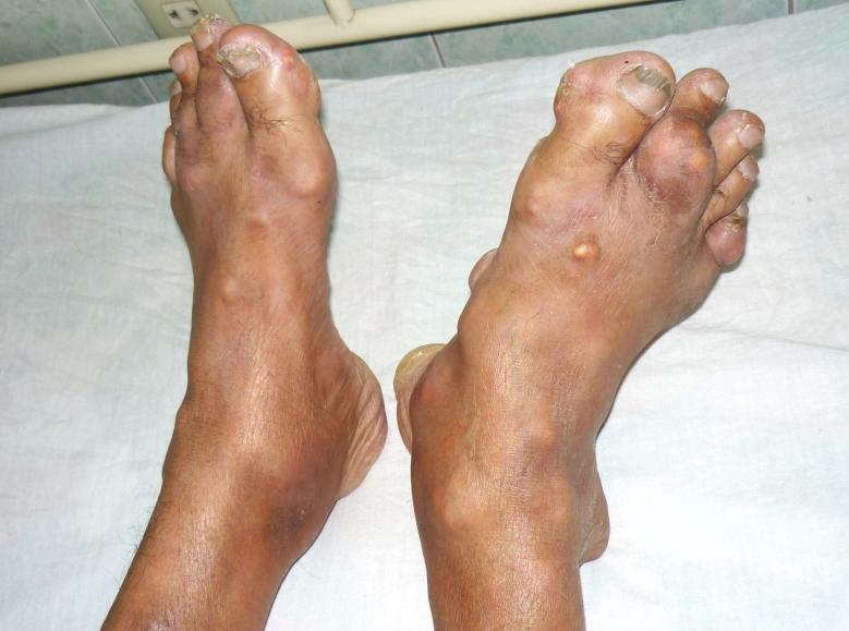 Gout là thể bệnh xuất hiện khi có sự rối loạn chuyển hóa purin trong Sh88bet đăng ký miễn phí dẫn đến dư thừa lượng axit uric, và chúng lắng đọng thành các tinh thể muối urat sắc nhọn ở các khớp xương gây viêm nhiễm.