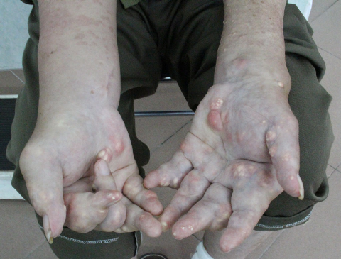 Ngoài ra, mắc gout nặng bệnh nhân phải điều trị các bệnh kèm theo như rối loạn lipid máu, tăng huyết áp, đái tháo đường, nhiễm khuẩn khớp, suy thận, viêm tụy.