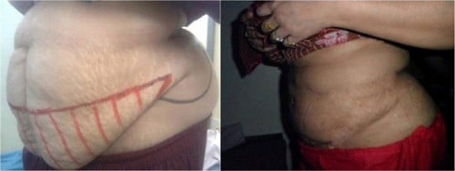 Quá trình hút mỡ bụng cũng gây nhiều rủi do các chị em cần chú ý.
