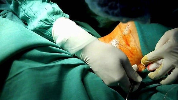 Bác sỹ khâu lại vùng bụng của bệnh nhân.