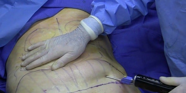 Mỡ thừa là nỗi ám ảnh của nhiều chị em.