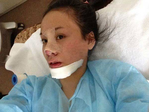 Đồng thời cô cũng gọt nhỏ cánh mũi.